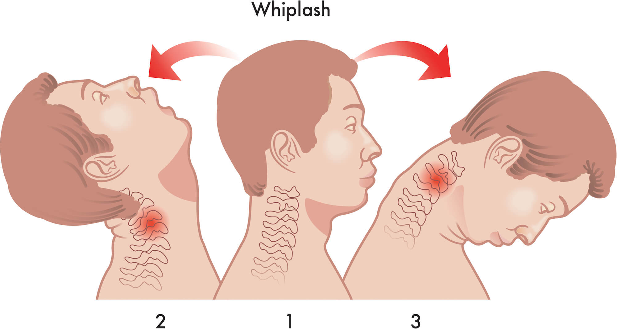 Illustration of the motions of a neck whiplash injury