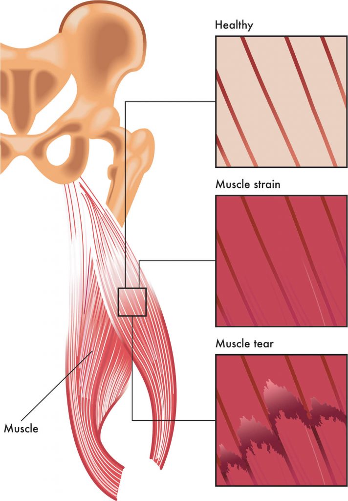 Illustration of human muscle comparing the difference between healthy, strained and torn muscle tissue