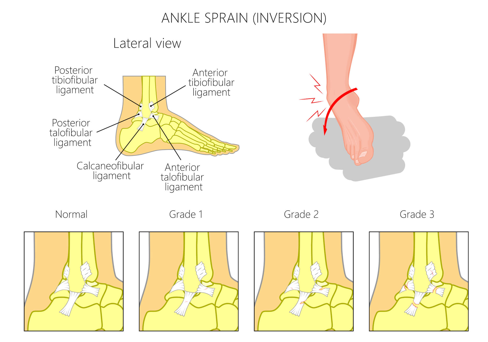 Illustration of varying grades of ankle sprains